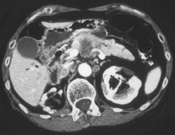 Pancreatic Cancer - CTisus CT Scan