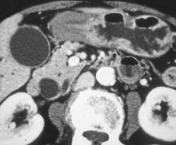 Ampullary Cancer - Look Inside Common Bile Duct - CTisus CT Scan