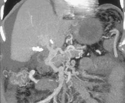 Pancreatic Cancer Occludes Portal Vein With Collaterals - CTisus CT Scan