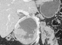 Neuroendocrine Tumor Invades the Portal Vein - CTisus CT Scan