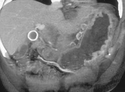 Gastric Cancer Invades the Pancreas - CTisus CT Scan