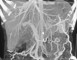 Collaterals Due to Splenic Vein Occlusion - CTisus CT Scan