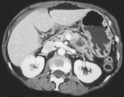 Pancreatic Cancer - CTisus CT Scan