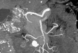 SMA Encased By Tumor - CTisus CT Scan