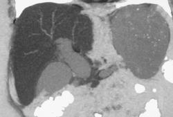 Dilated Common Bile Duct Due to Tumor - CTisus CT Scan