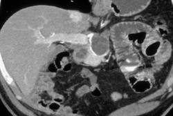 Cystadenocarcinoma- Yet Looks Benign - CTisus CT Scan