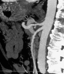 Celiac Artery Encased By Tumor - CTisus CT Scan