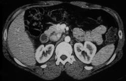 Insulinoma - CTisus CT Scan