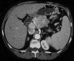 Islet Cell Tumor - CTisus CT Scan