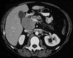 Peripancreatic Nodes - CTisus CT Scan