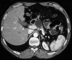 Cystadenoma - CTisus CT Scan