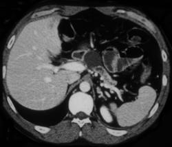 Cystadenoma - CTisus CT Scan