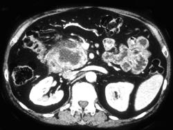 Islet Cell Cancer of the Pancreas - CTisus CT Scan