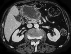 Cystic Tumor of the Pancreas - CTisus CT Scan