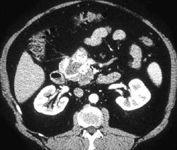 Islet Cell Tumor of the Pancreatic Head - CTisus CT Scan