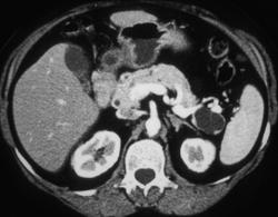 Intraductal Papillary Mucinous Neoplasm (IPMN) - CTisus CT Scan