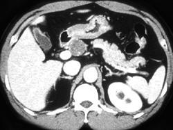 Cystic Lesion of the Head of the Pancreas - CTisus CT Scan
