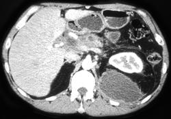 Pancreatitis With Pseudocyst in Left Posterior Pararenal Space - CTisus CT Scan