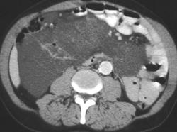Lymphangioma - CTisus CT Scan