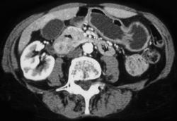 Duodenal Diverticulum - CTisus CT Scan