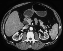 Ampullary Cancer - CTisus CT Scan