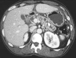 Chronic Pancreatitis - CTisus CT Scan