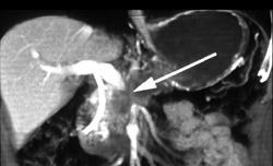 Pancreatic Adenocarcinoma Encases Superior Mesenteric Vein (SMV) Confluence - CTisus CT Scan