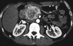 Non Functioning Islet Cell Tumor - CTisus CT Scan