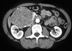 GIST Tumor of the Duodenum Simulates A Pancreatic Mass - CTisus CT Scan