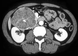 GIST Tumor - CTisus CT Scan