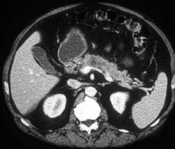 Pancreatic Adenocarcinoma - CTisus CT Scan