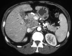 Pancreatic Adenocarcinoma - CTisus CT Scan