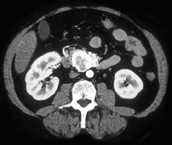 Islet Cell Tumor - CTisus CT Scan