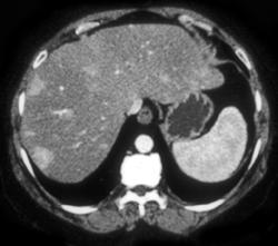 Liver Metastases From Islet Cell Tumor - CTisus CT Scan