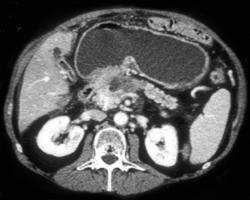 Pancreatic Cancer Invades the Duodenum - CTisus CT Scan