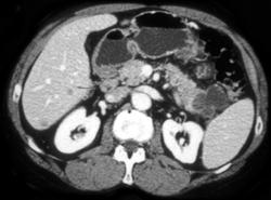 Cystadenocarcinoma of the Tail of the Pancreas - CTisus CT Scan