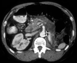 Post-op Pancreas - CTisus CT Scan