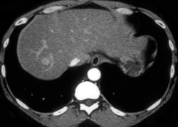 Vascular Metastases to the Liver From Pancreatic Cancer - CTisus CT Scan