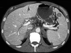 Pancreatic Cancer With Splenic and Adrenal Metastases - CTisus CT Scan