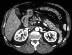 Intraductal Papillary Mucinous Neoplasm (IPMN) - CTisus CT Scan