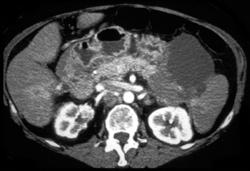 Pancreatic Cancer With Local Invasion and Splenic Vein Occlusion - CTisus CT Scan