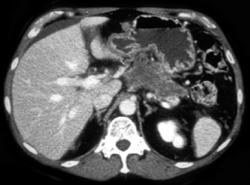 Invasive Pancreatic Cancer With Celiac Axis Occlusion - CTisus CT Scan