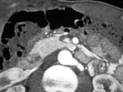 Normal Uncinate Process - CTisus CT Scan