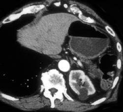 Intraductal Papillary Mucinous Neoplasm (IPMN) of the Tail of the Pancreas - CTisus CT Scan