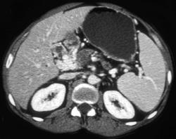 Cavernous Transformation of the Portal Vein - CTisus CT Scan