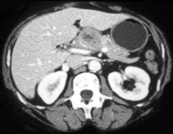 Nodes Simulate Pancreatic Mass - CTisus CT Scan