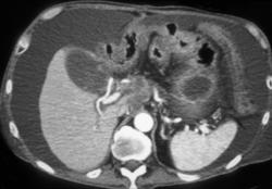 Pancreatic Adenocarcinoma With Vessel Encasement - CTisus CT Scan