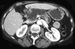 Large Intraductal Papillary Mucinous Neoplasm (IPMN) - CTisus CT Scan