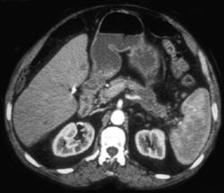 Carcinoma of the Tail of the Pancreas Encases the Splenic Vein - CTisus CT Scan