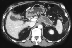 Pancreatic Adenocarcinoma With Implants - CTisus CT Scan